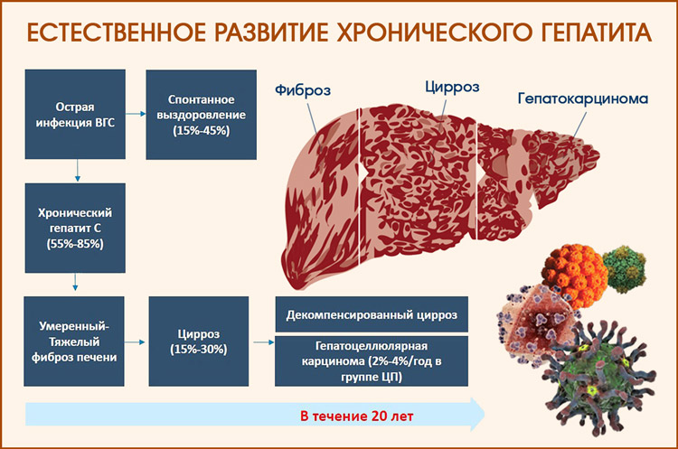 Лечение острого вирусного гепатита С